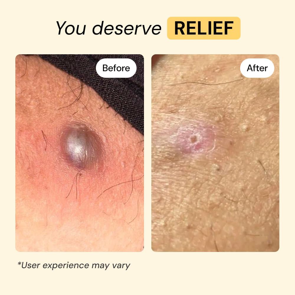 MyMagicHealer Universal Flare Care – Multi-Purpose Solution | Skin Flare-Ups - Hidradenitis Suppurativa, Folliculitis, Boils, Cysts | Anti-Chafing | Irritated Skin Relief w/Propolis & Egg Yolk 1 oz