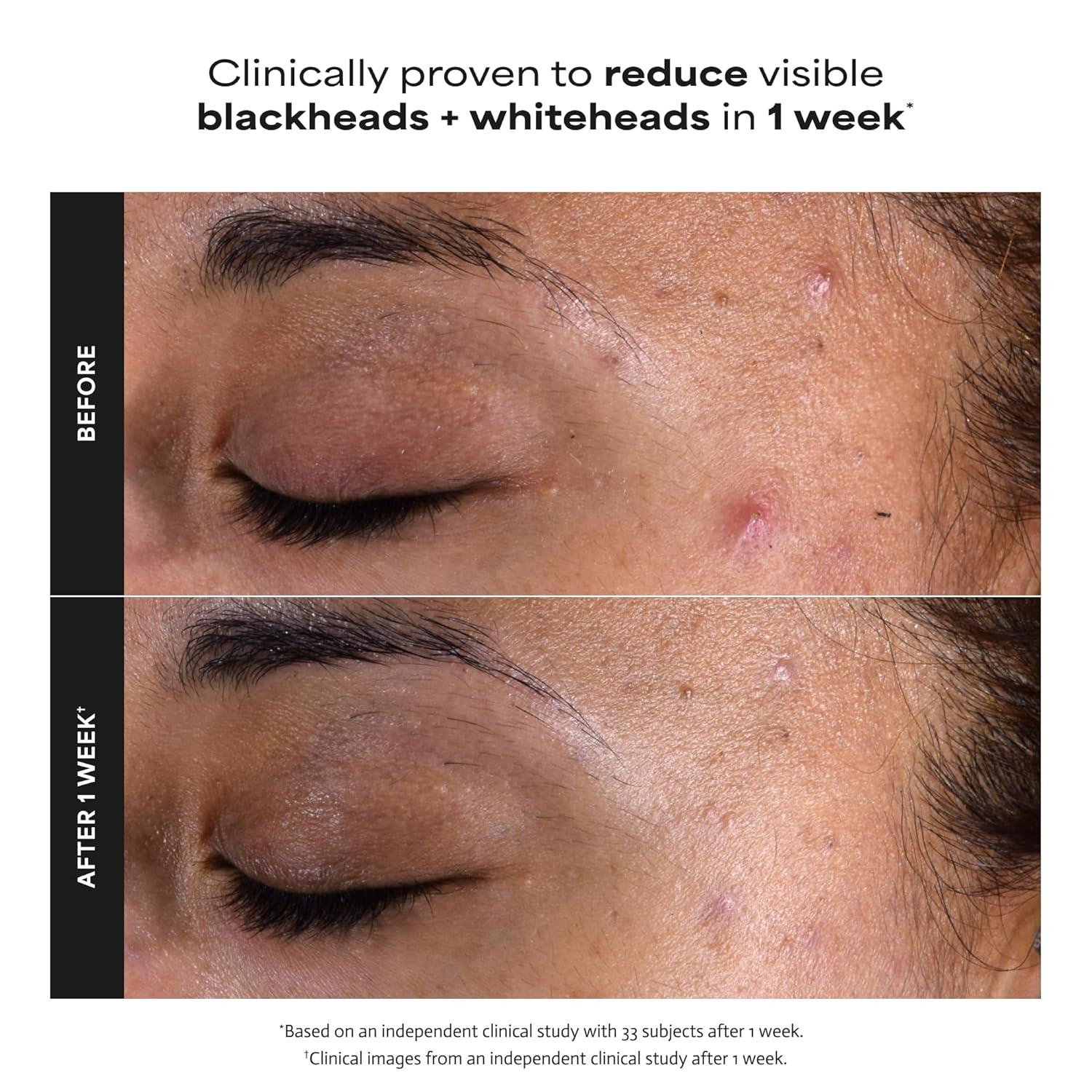 Paula's Choice SKIN PERFECTING 2% BHA Liquid Exfoliant with Salicylic Acid, Facial Polish for Enlarged Pores, Wrinkles & Fine Lines, Suitable for Blackhead-Prone Skin, Fragrance-Free